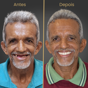 Paciente reabilitado com implante dentário e prótese protocolo na Oral Fácil Prime em Irecê BA