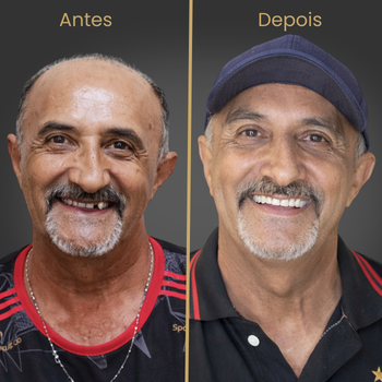 Paciente reabilitado com implante dentário e prótese protocolo na Oral Fácil Prime em Irecê BA