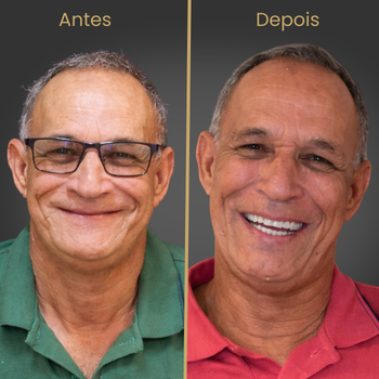 Paciente reabilitado com implante dentário e prótese protocolo na Oral Fácil Prime em Irecê BA